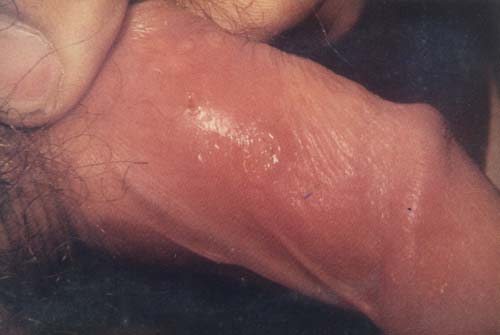 Ringworm On The Penis